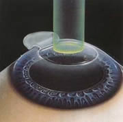 LASEK diagram, showing a virtual eye with the surface peeled back and a laser beaming in.